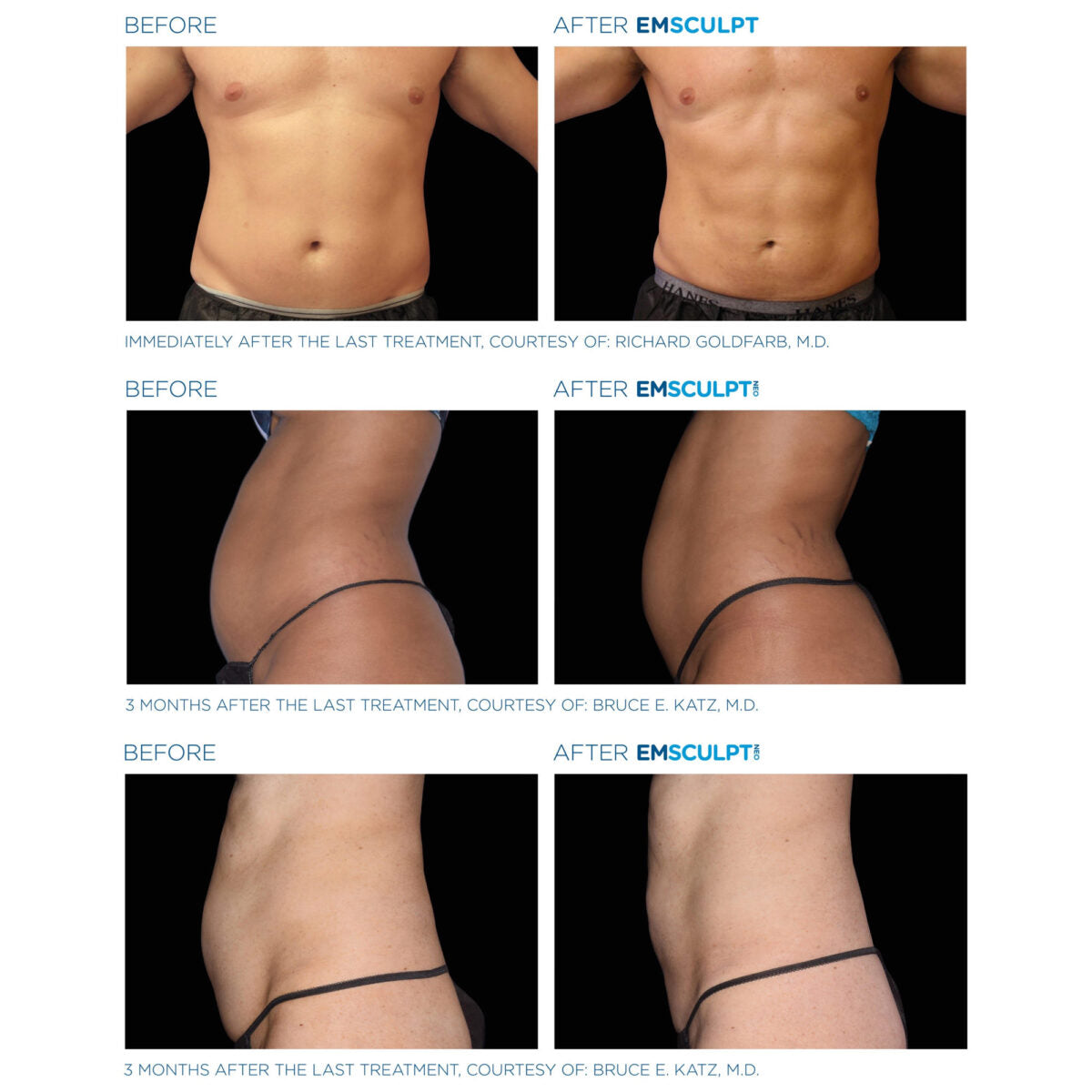 New York Emsculpt Body Contouring